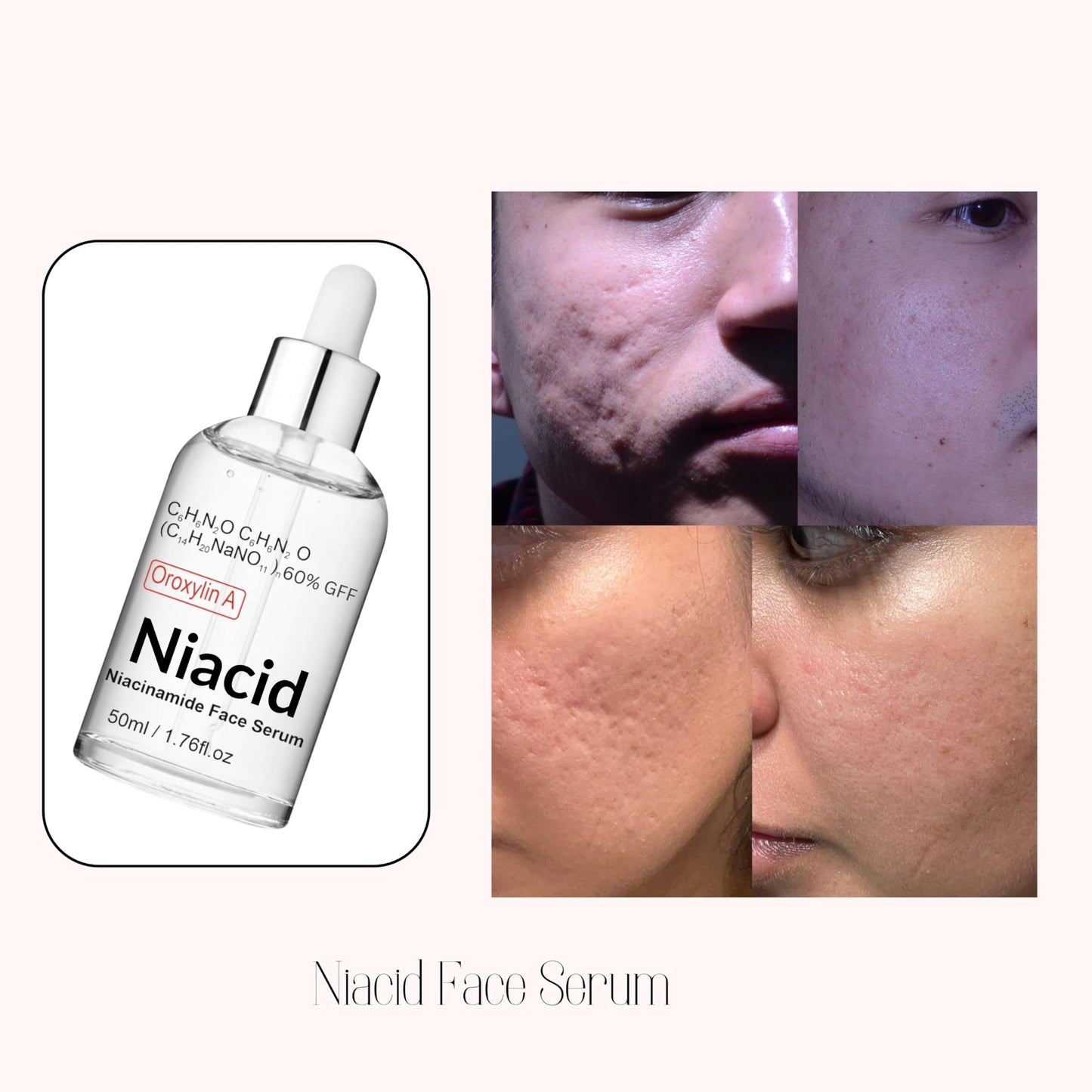 Niacid Face Serum for Pitted Scars & Dark Acne