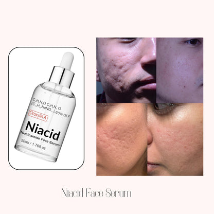 Niacid Face Serum for Pitted Scars & Dark Acne